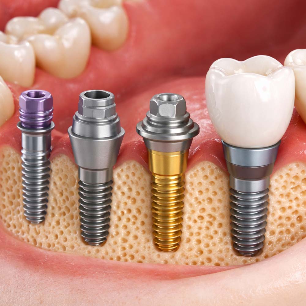 Digital Prosthetic Component