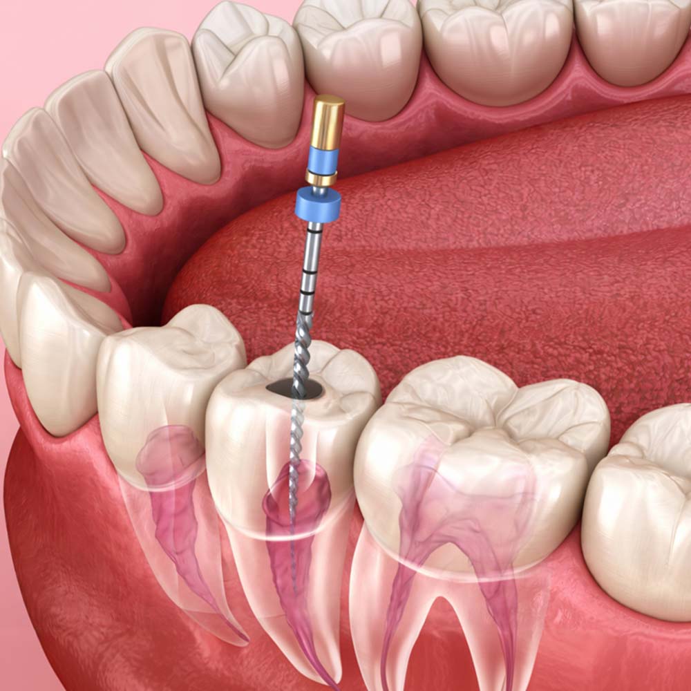 Endodonics